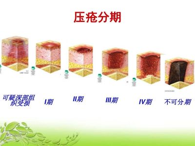 压疮最新分期与小巷特色小店探秘