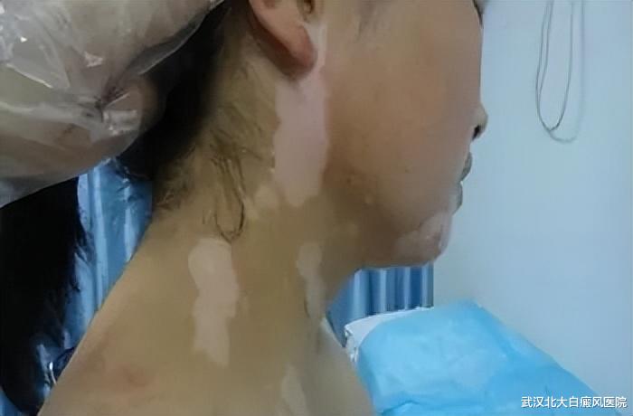 白癜风的最新疗法，重塑生活色彩，重拾自信与希望之路