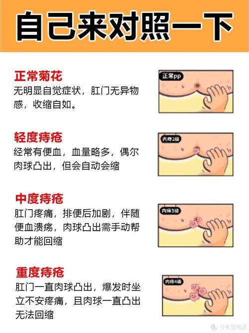 最新痔疮治疗方法，告别痔疮困扰！