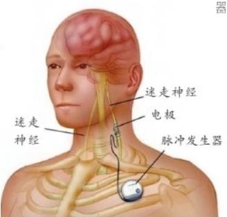 最新癫痫治疗方法概览，最新疗法全解析