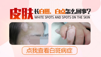白斑病最新疗法揭秘，小巷深处的秘密小店